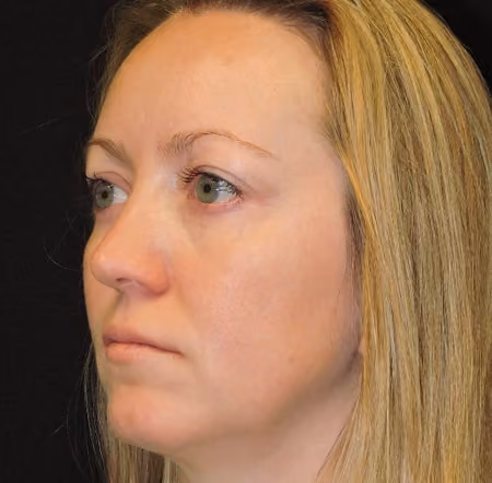 Halo before and after, case 1579 - Cool Springs Plastic Surgery