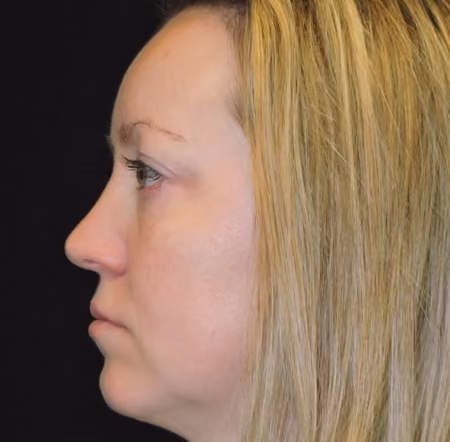 Halo before and after, case 1579 - Cool Springs Plastic Surgery