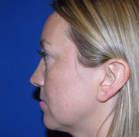 Halo before and after, case 1579 - Cool Springs Plastic Surgery