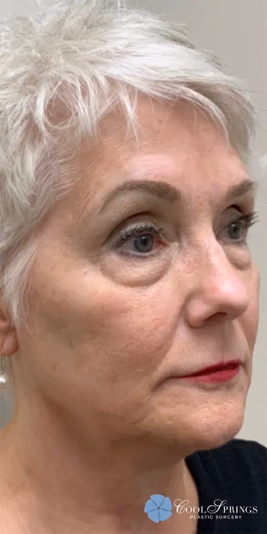 BBL before and after, case 12317 - Cool Springs Plastic Surgery
