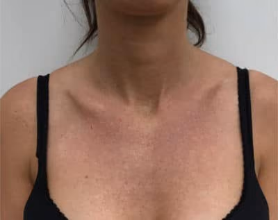 BBL before and after, case 16341 - Cool Springs Plastic Surgery