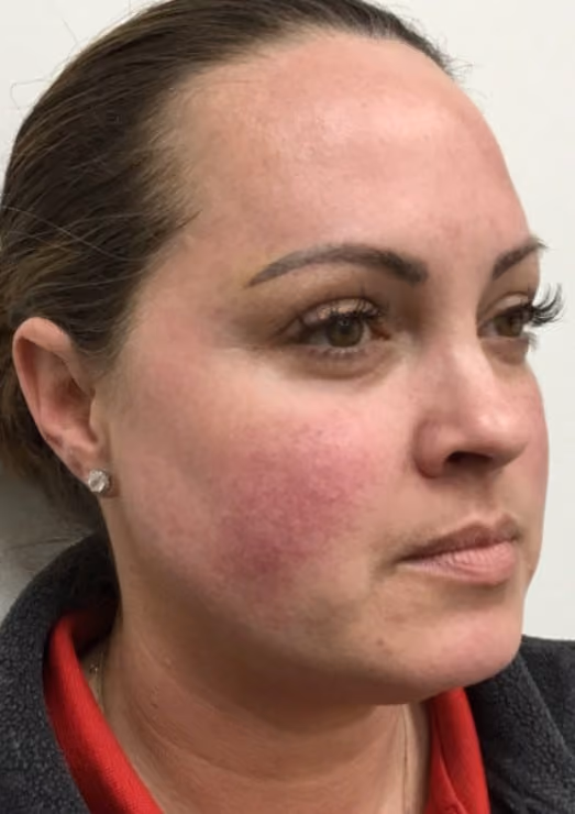 Halo before and after, case 24003 - Cool Springs Plastic Surgery