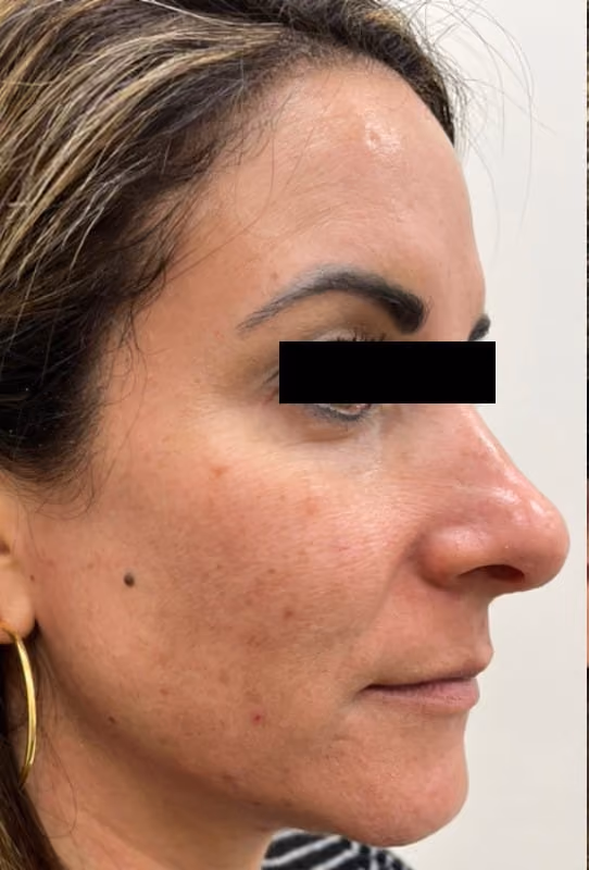BBL before and after, case 27481 - Cool Springs Plastic Surgery