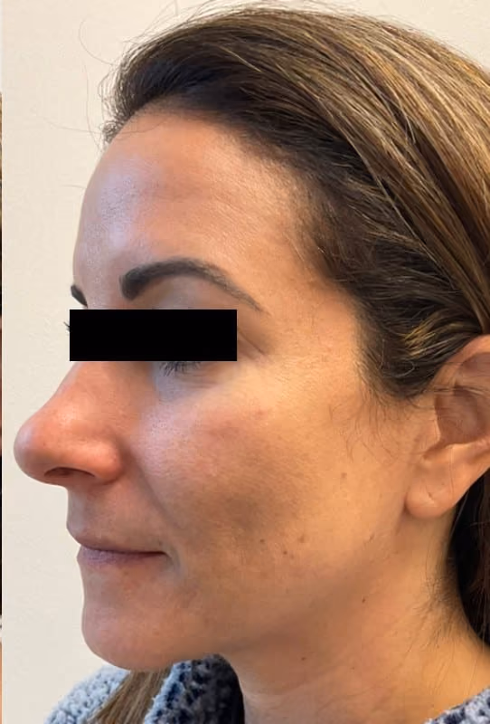 BBL before and after, case 27481 - Cool Springs Plastic Surgery