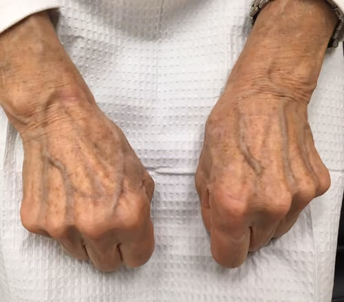 BBL before and after, case 5746 - Cool Springs Plastic Surgery