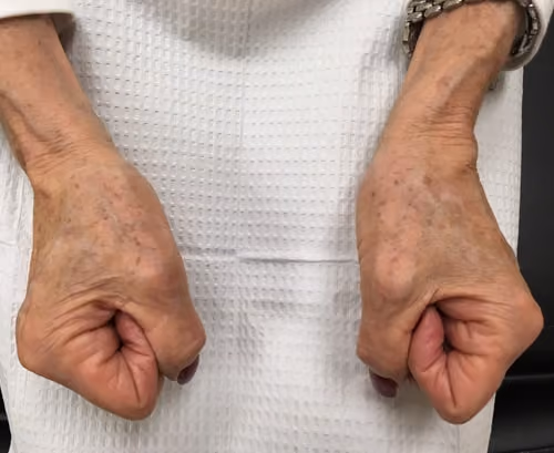 BBL before and after, case 5746 - Cool Springs Plastic Surgery