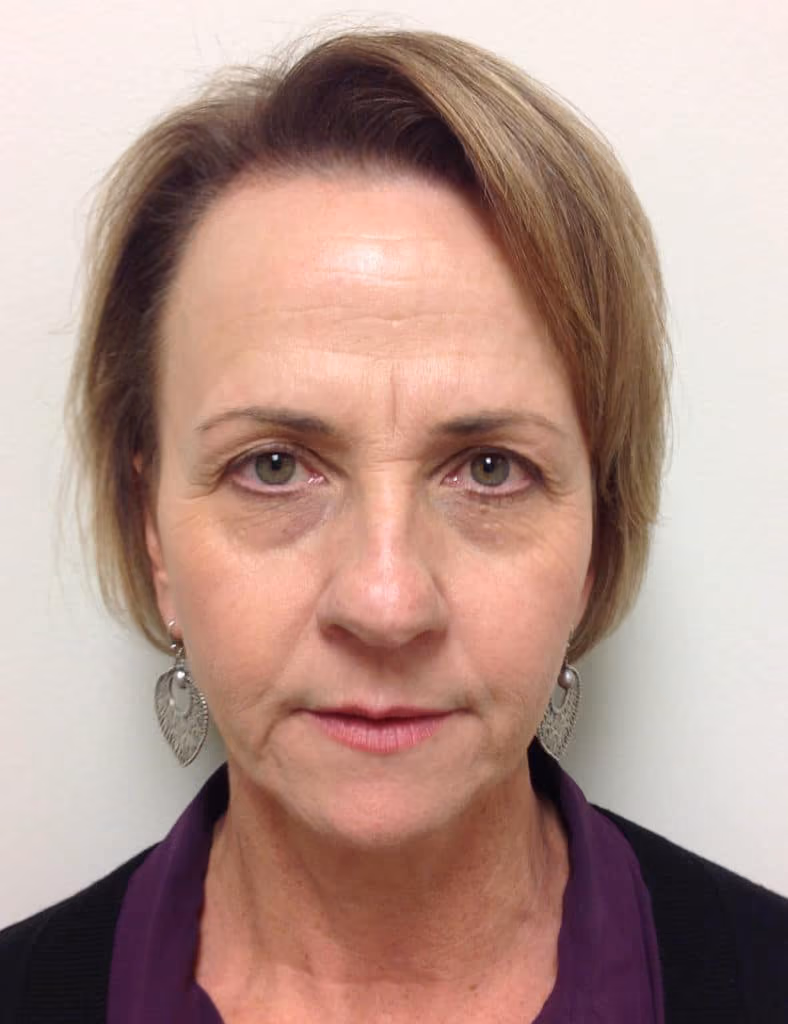 BBL before and after, case 6875 - Cool Springs Plastic Surgery