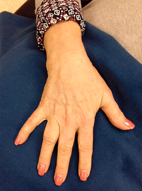 BBL before and after, case 6885 - Cool Springs Plastic Surgery