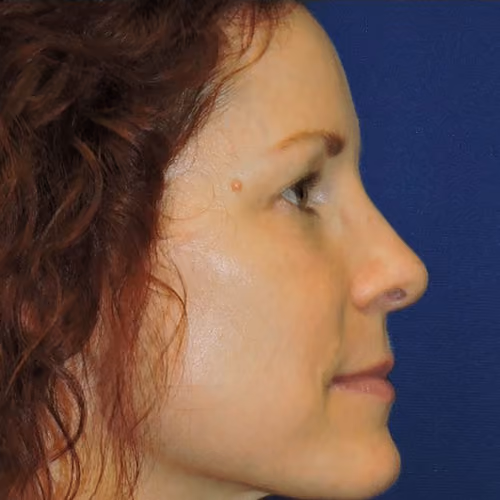 Halo before and after, case 8034 - Cool Springs Plastic Surgery