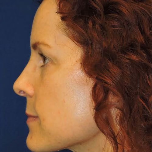 Halo before and after, case 8034 - Cool Springs Plastic Surgery