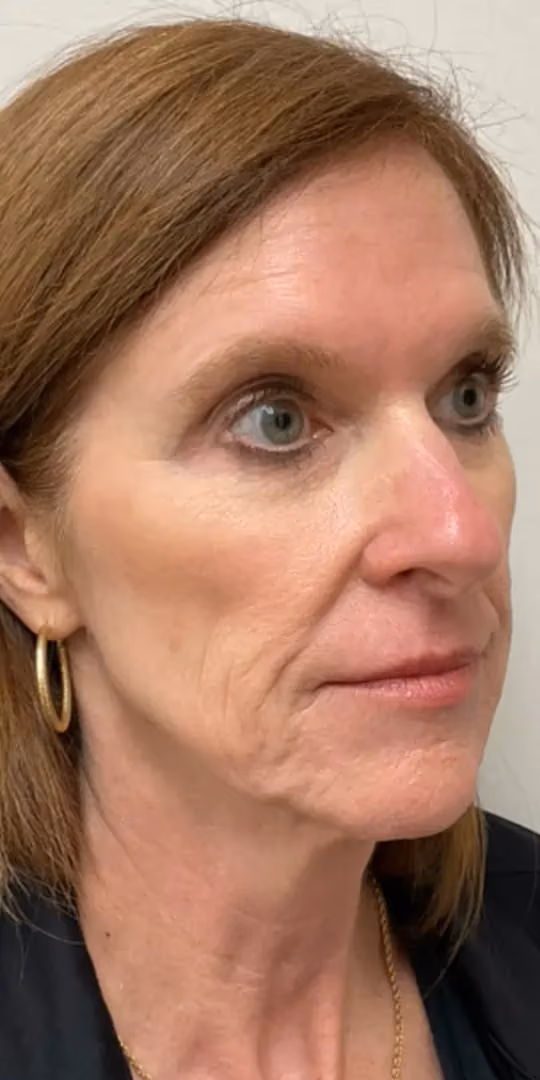 Chemical Peels before and after, case 12296 - Cool Springs Plastic Surgery