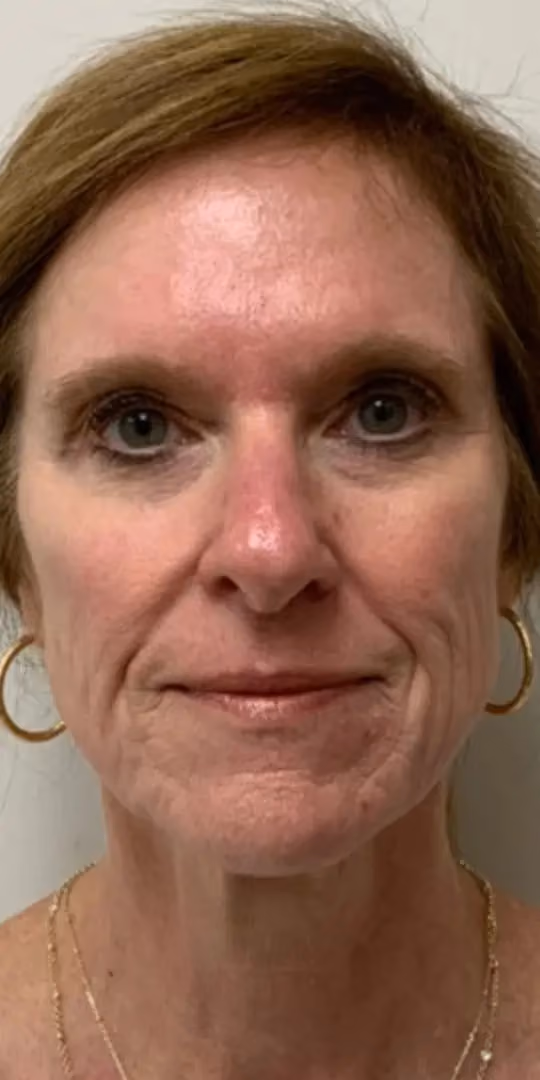 Chemical Peels before and after, case 12296 - Cool Springs Plastic Surgery