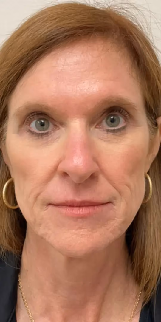 Chemical Peels before and after, case 12296 - Cool Springs Plastic Surgery