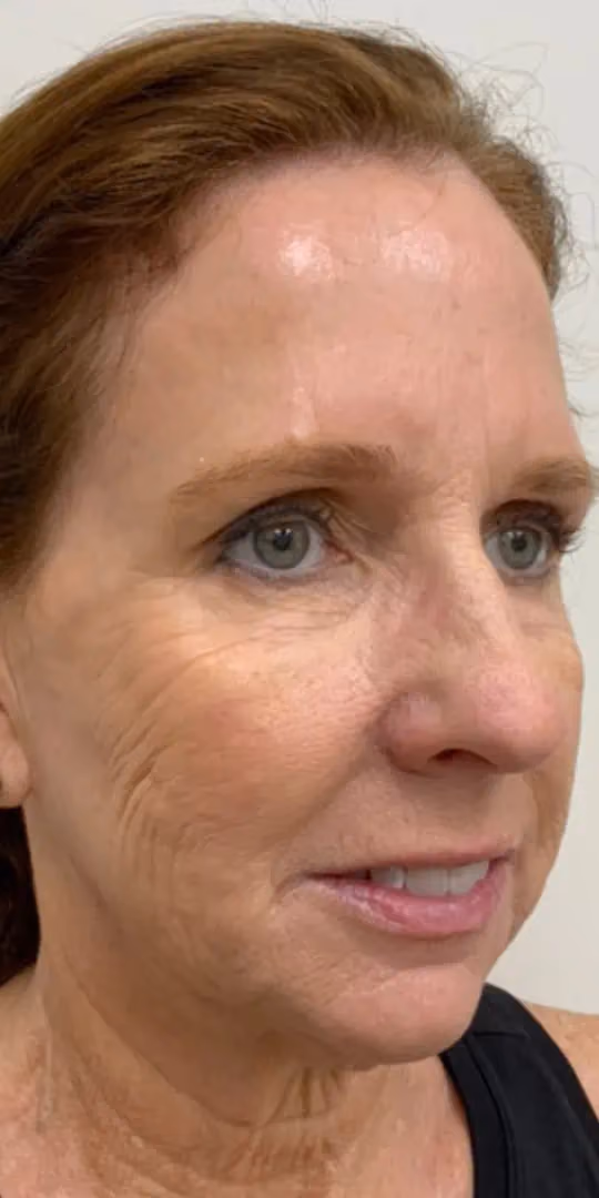 Chemical Peels before and after, case 12303 - Cool Springs Plastic Surgery