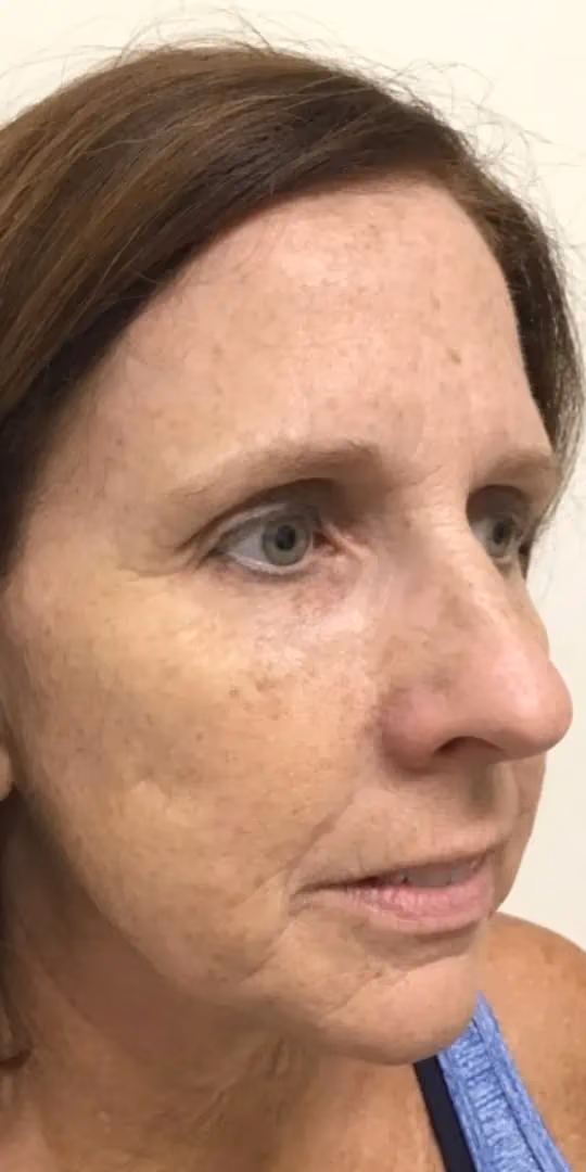 Chemical Peels before and after, case 12303 - Cool Springs Plastic Surgery