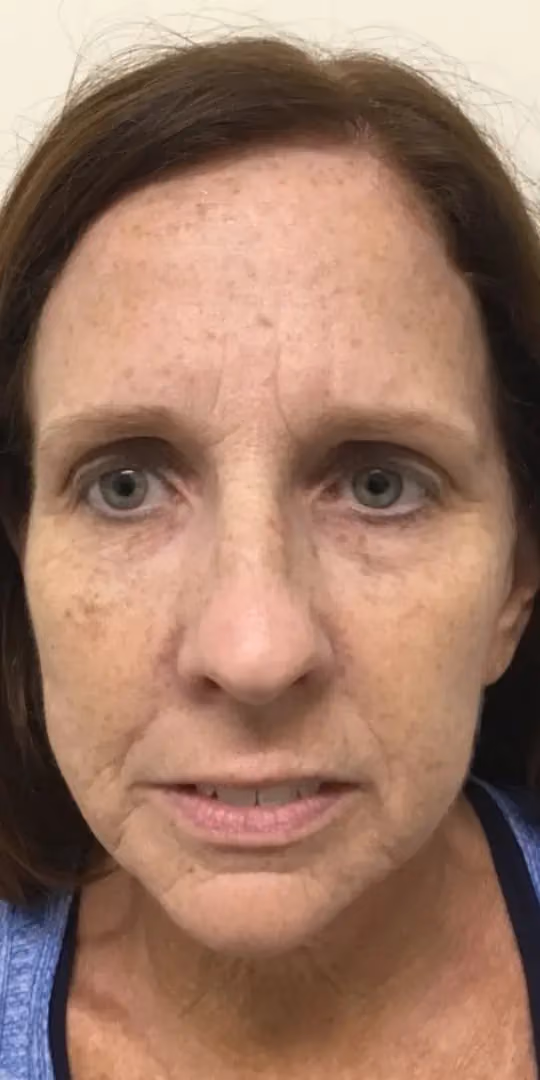Chemical Peels before and after, case 12303 - Cool Springs Plastic Surgery