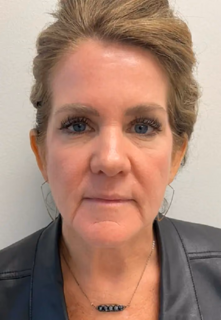 Chemical Peels before and after, case 15780 - Cool Springs Plastic Surgery