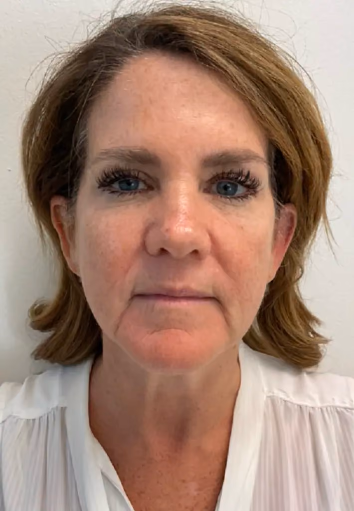 Chemical Peels before and after, case 15780 - Cool Springs Plastic Surgery