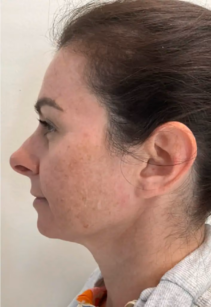 Chemical Peels before and after, case 15780-2 - Cool Springs Plastic Surgery