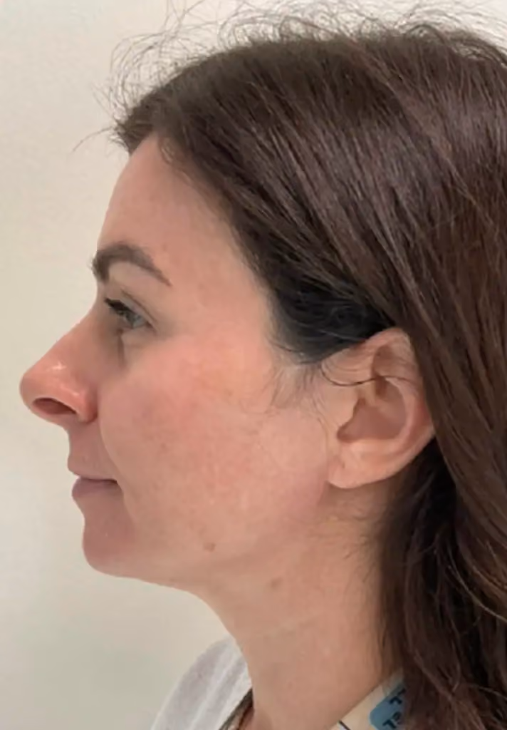 Chemical Peels before and after, case 15780-2 - Cool Springs Plastic Surgery