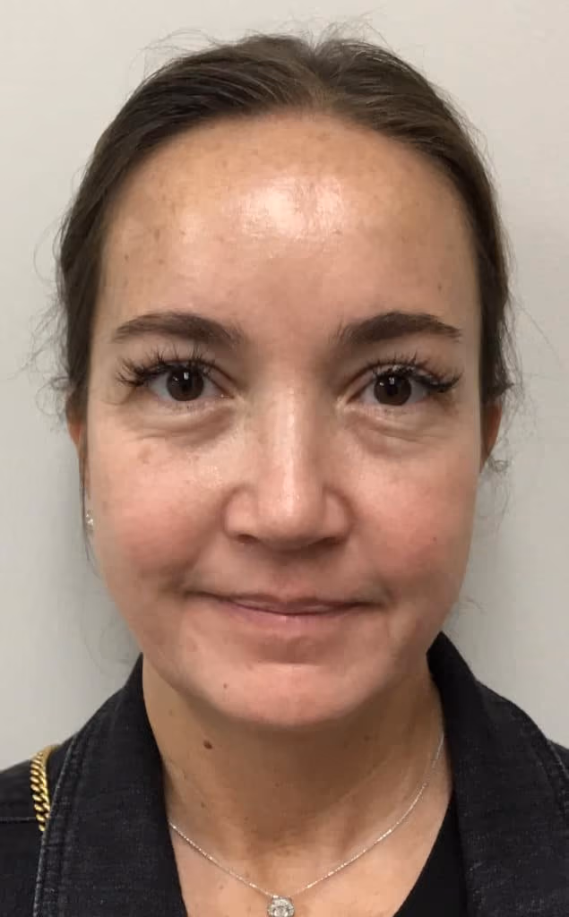 Chemical Peels before and after, case 16561 - Cool Springs Plastic Surgery
