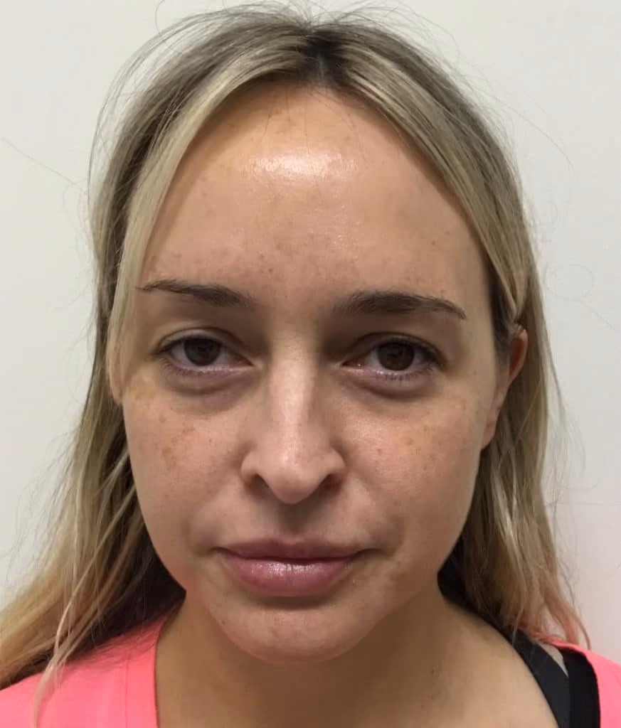 Chemical Peels before and after, case 16815 - Cool Springs Plastic Surgery