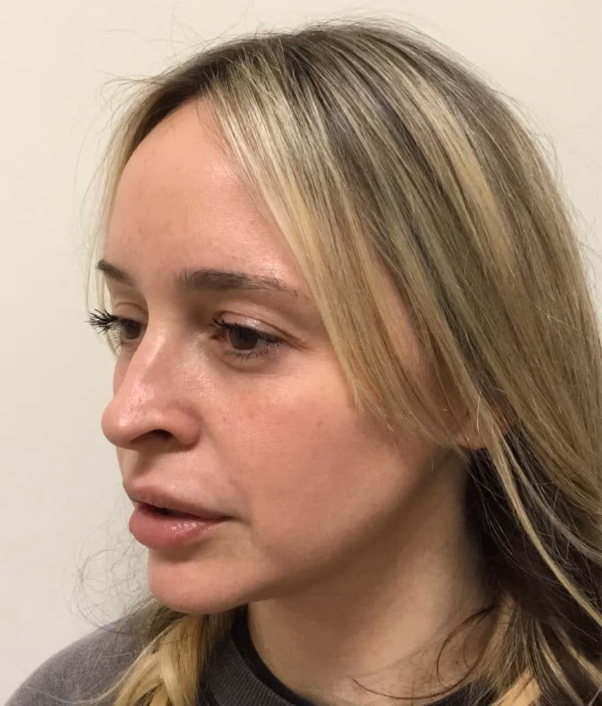 Chemical Peels before and after, case 16815 - Cool Springs Plastic Surgery