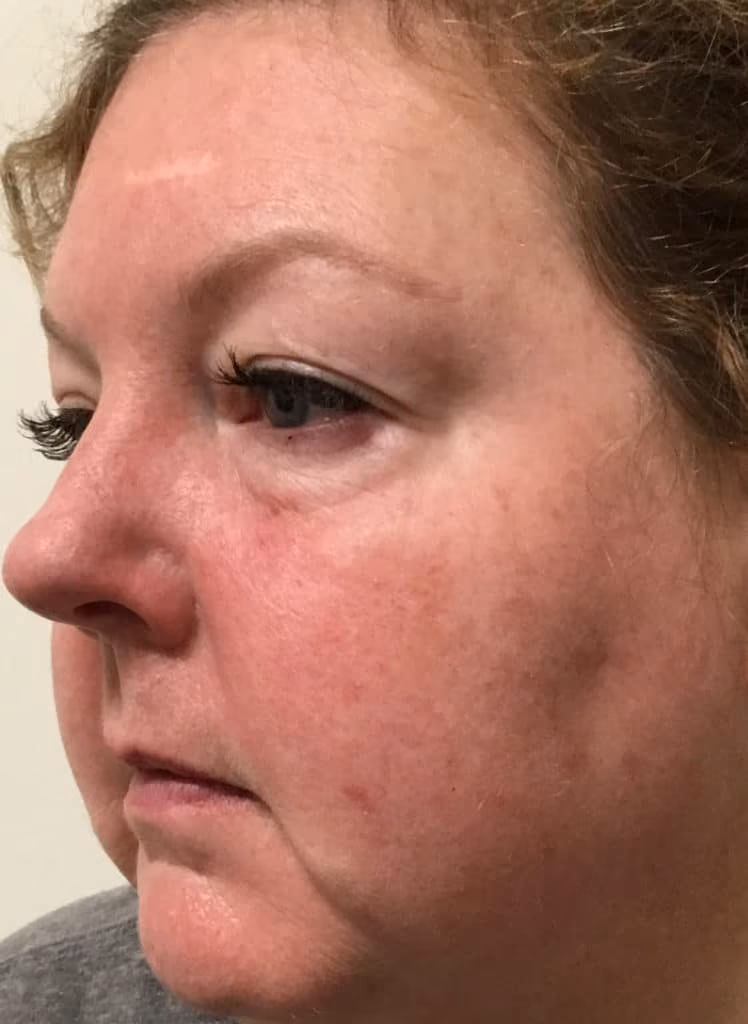 Chemical Peels before and after, case 16823 - Cool Springs Plastic Surgery