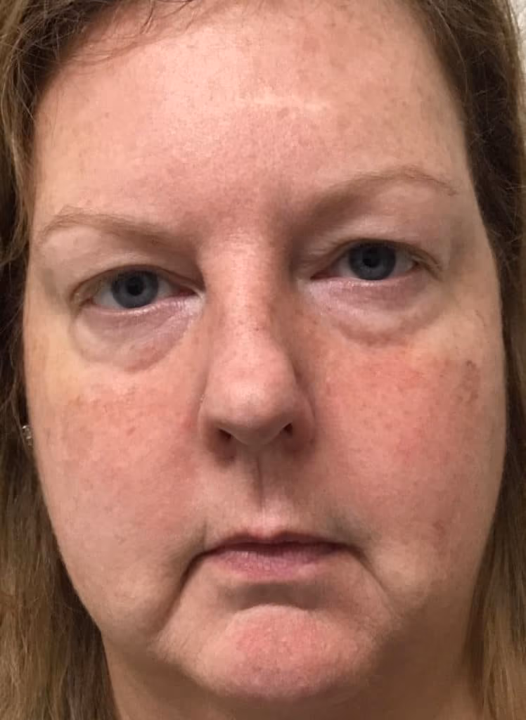 Chemical Peels before and after, case 16823 - Cool Springs Plastic Surgery