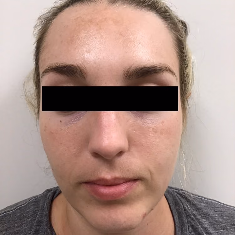 Chemical Peels before and after, case 16964 - Cool Springs Plastic Surgery