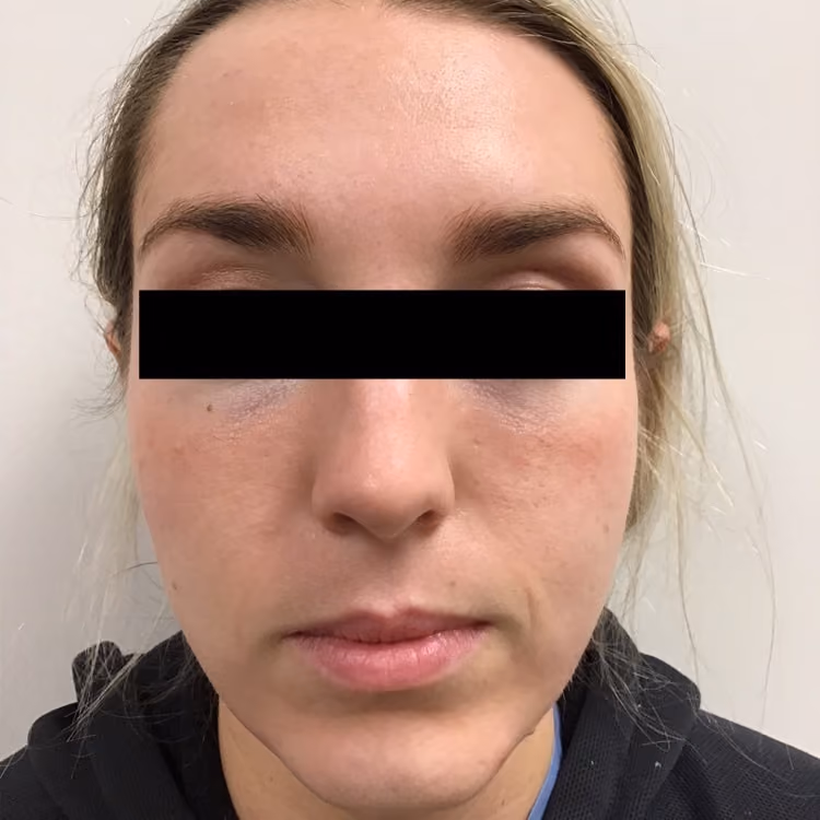 Chemical Peels before and after, case 16964 - Cool Springs Plastic Surgery