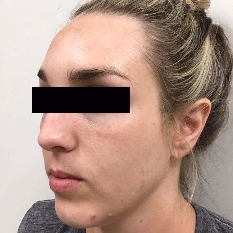 Chemical Peels before and after, case 16964 - Cool Springs Plastic Surgery