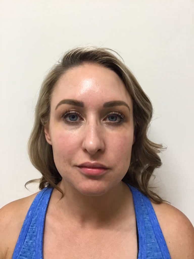 Chemical Peels before and after, case 17431 - Cool Springs Plastic Surgery
