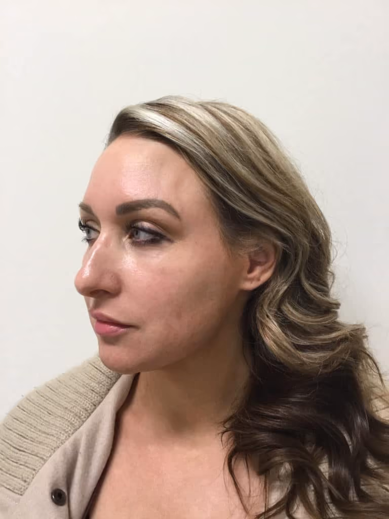Chemical Peels before and after, case 17431 - Cool Springs Plastic Surgery