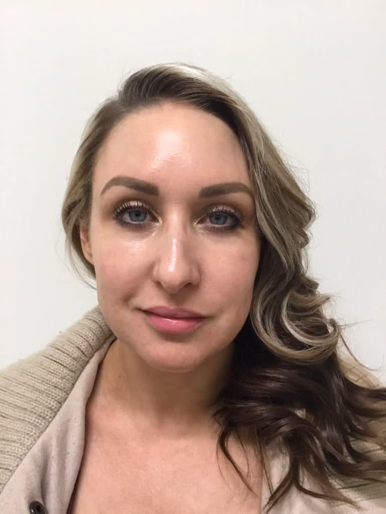 Chemical Peels before and after, case 17431 - Cool Springs Plastic Surgery