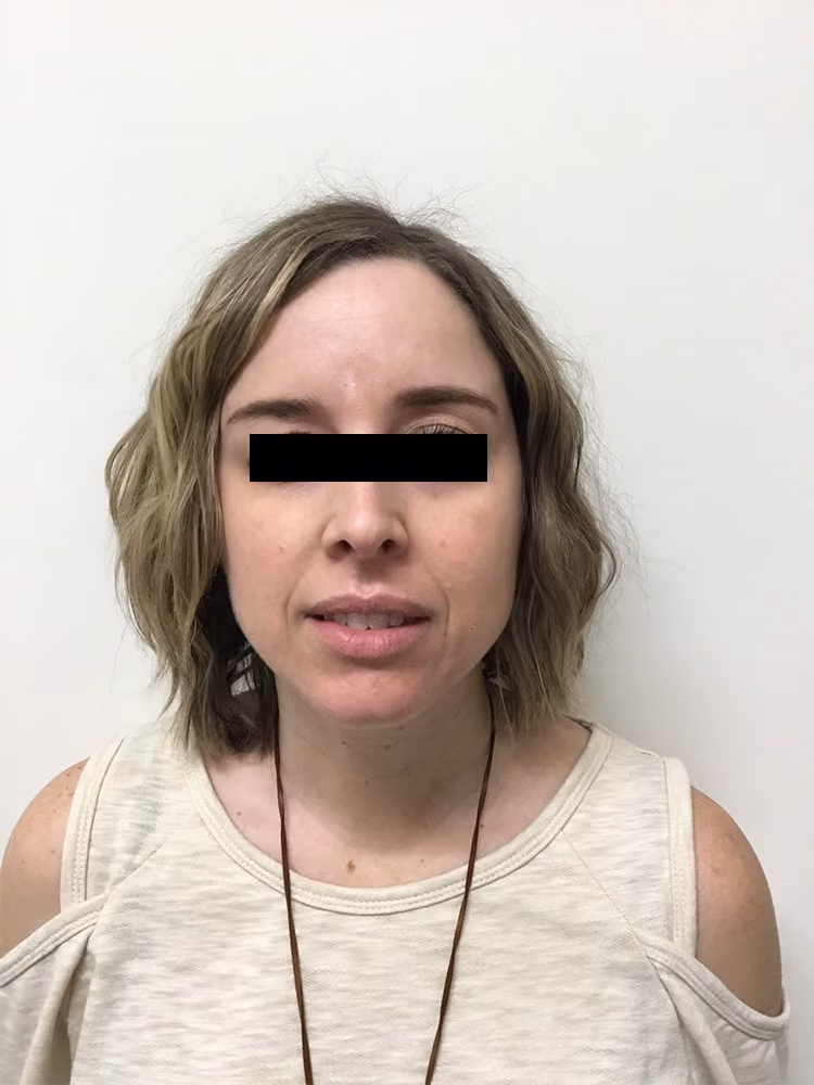 Chemical Peels before and after, case 17464 - Cool Springs Plastic Surgery