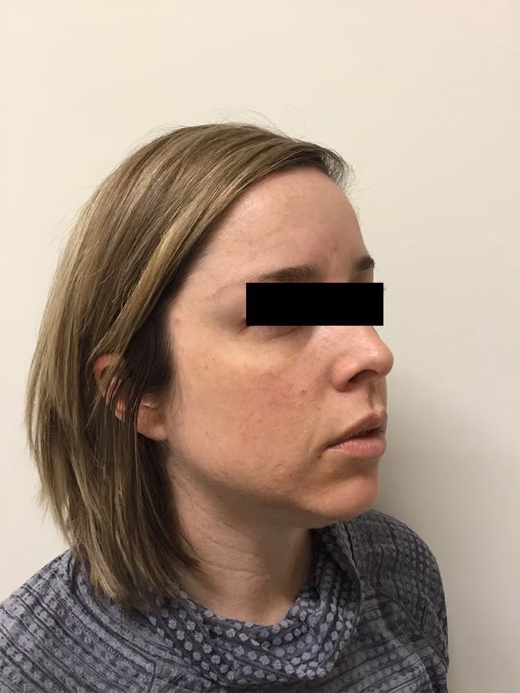 Chemical Peels before and after, case 17464 - Cool Springs Plastic Surgery