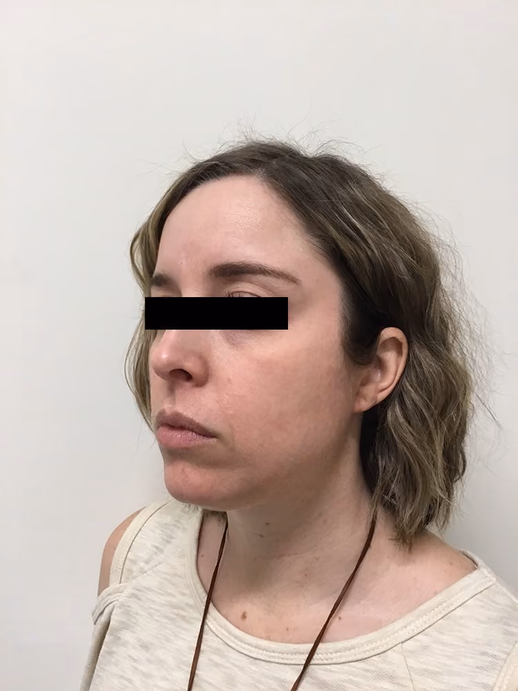 Chemical Peels before and after, case 17464 - Cool Springs Plastic Surgery