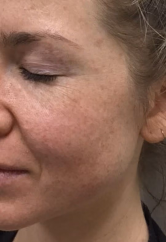 Chemical Peels before and after, case 18730 - Cool Springs Plastic Surgery