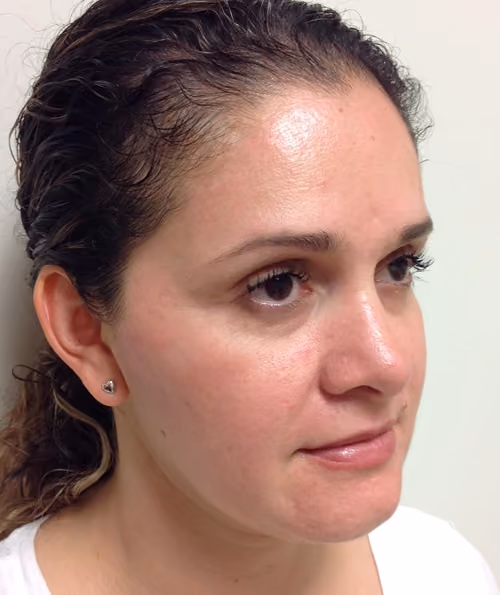 Chemical Peels before and after, case 5206 - Cool Springs Plastic Surgery