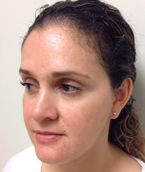 Chemical Peels before and after, case 5206 - Cool Springs Plastic Surgery