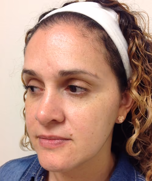 Chemical Peels before and after, case 5206 - Cool Springs Plastic Surgery