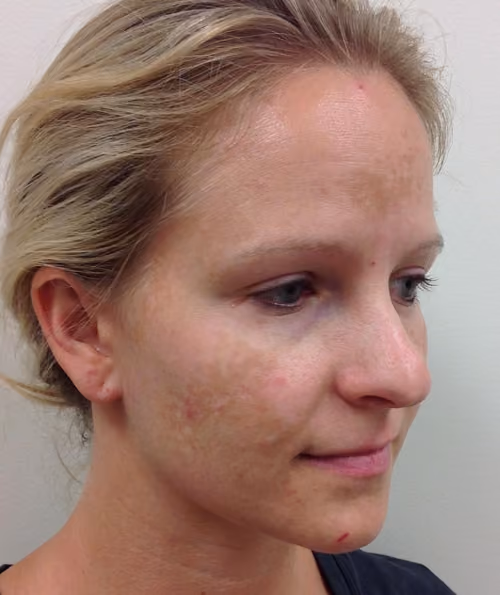 Chemical Peels before and after, case 5214 - Cool Springs Plastic Surgery
