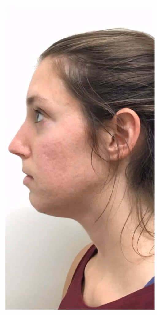 Microneedling before and after, case 12132 - Cool Springs Plastic Surgery