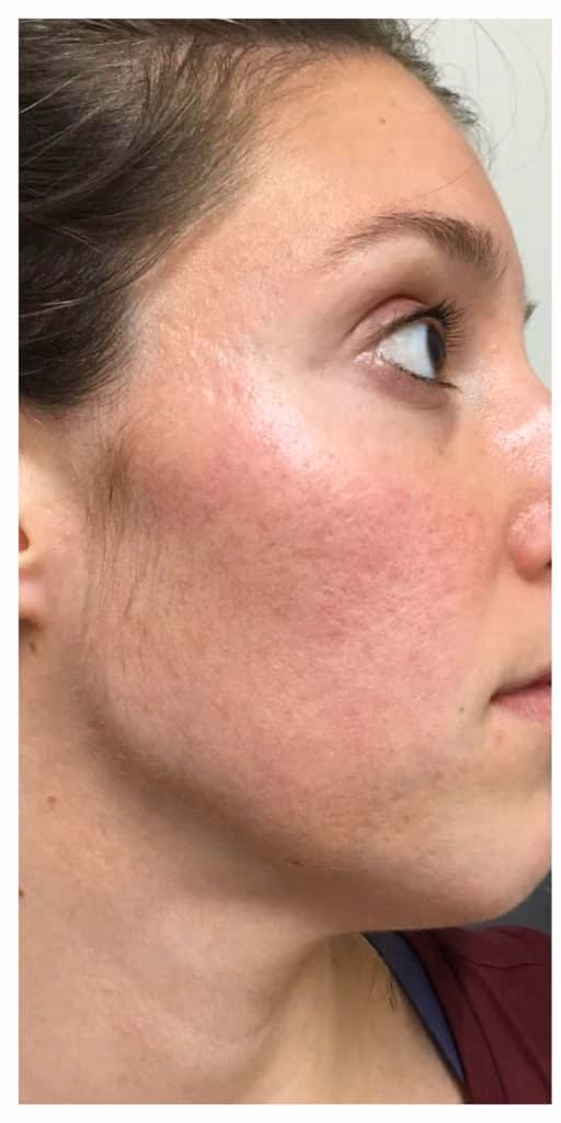 Microneedling before and after, case 12132 - Cool Springs Plastic Surgery