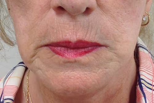 Before microneedling skin texture lower face Nashville — Cool Springs Plastic Surgery