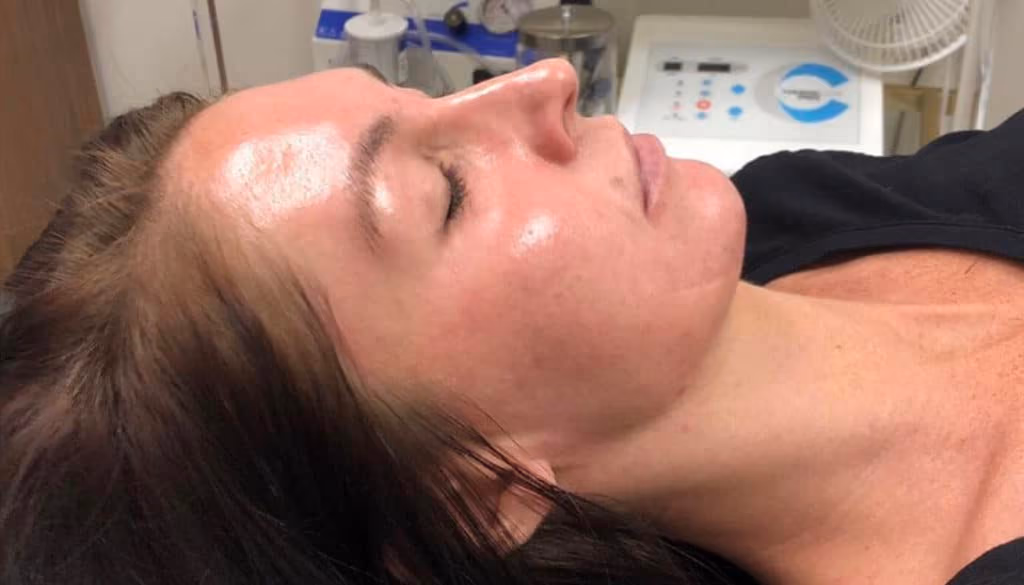 HydraFacial before and after, case 11445 - Cool Springs Plastic Surgery