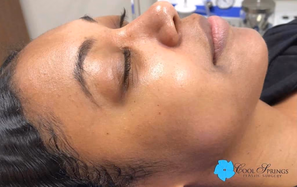 HydraFacial before and after, case 11449 - Cool Springs Plastic Surgery