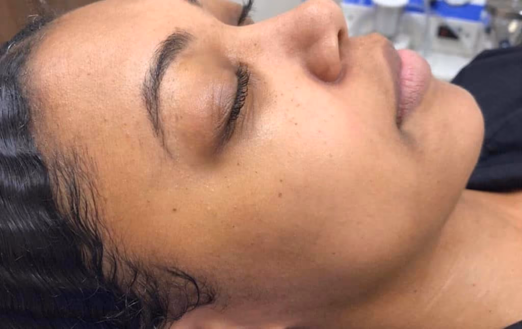 HydraFacial before and after, case 11449 - Cool Springs Plastic Surgery