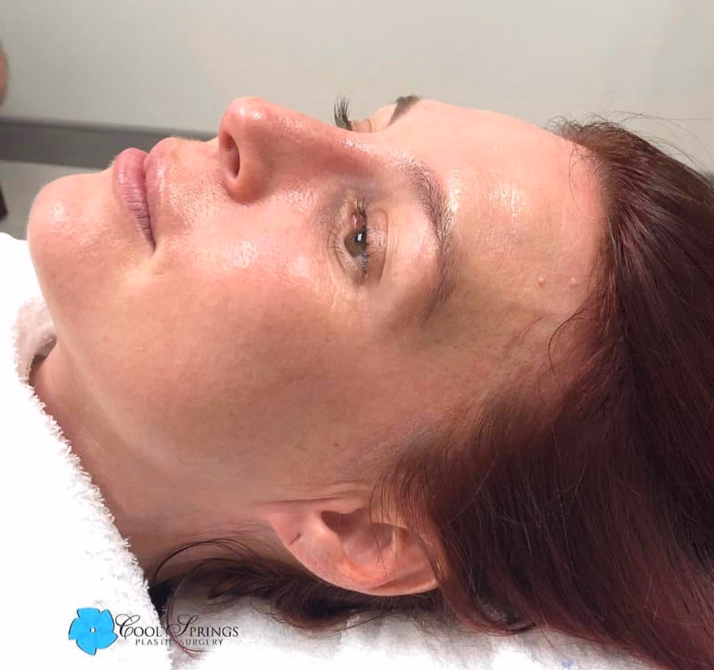 HydraFacial before and after, case 12808 - Cool Springs Plastic Surgery